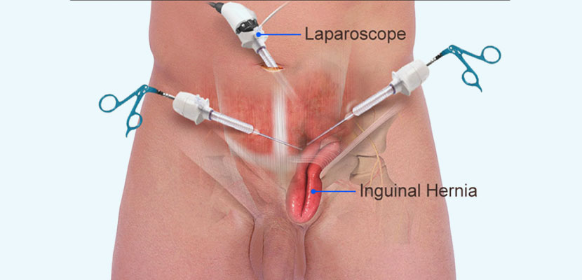 Laparoscopic Operation for Hernia