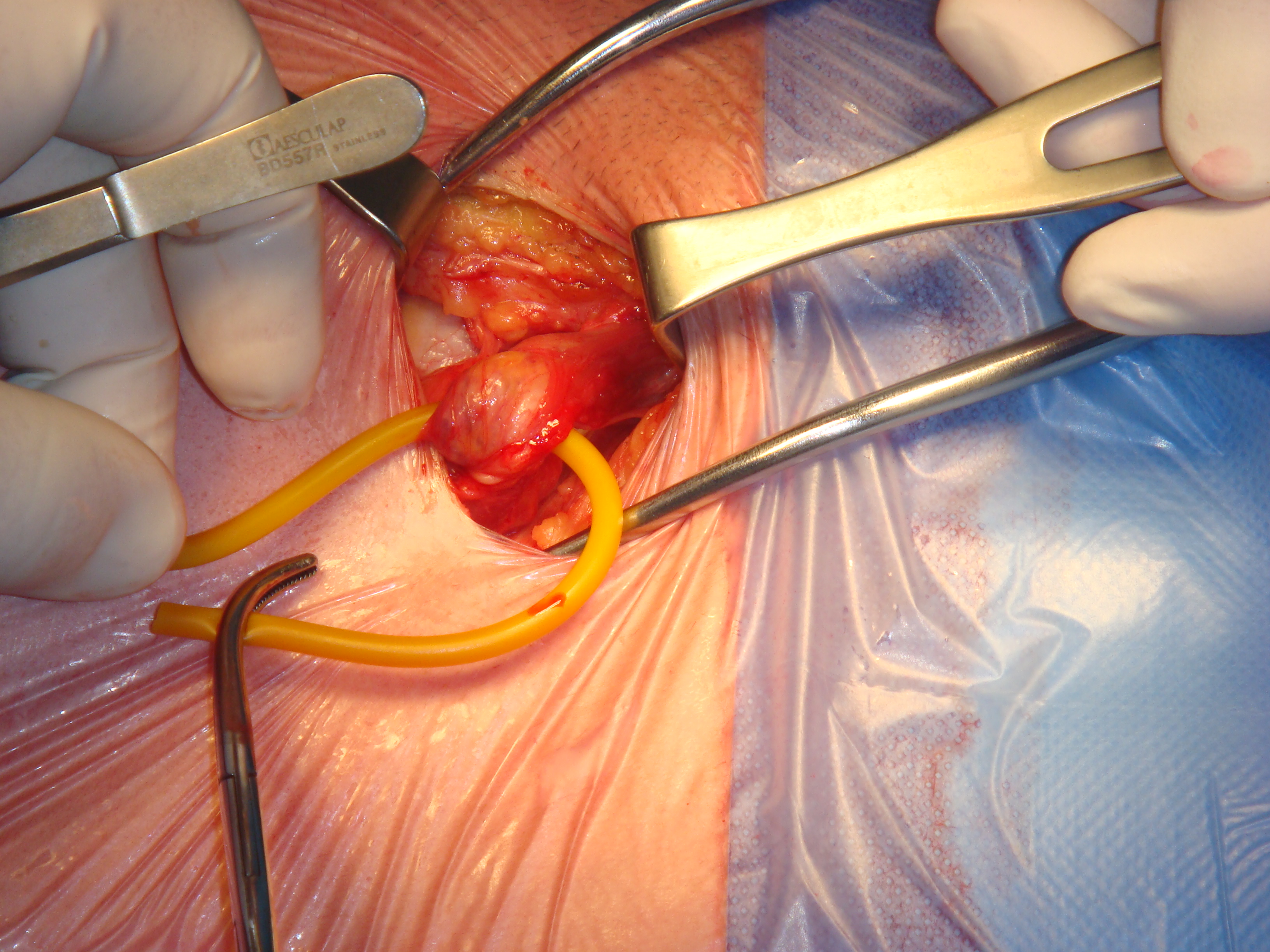 Inguinal Hernia Repair Surgery