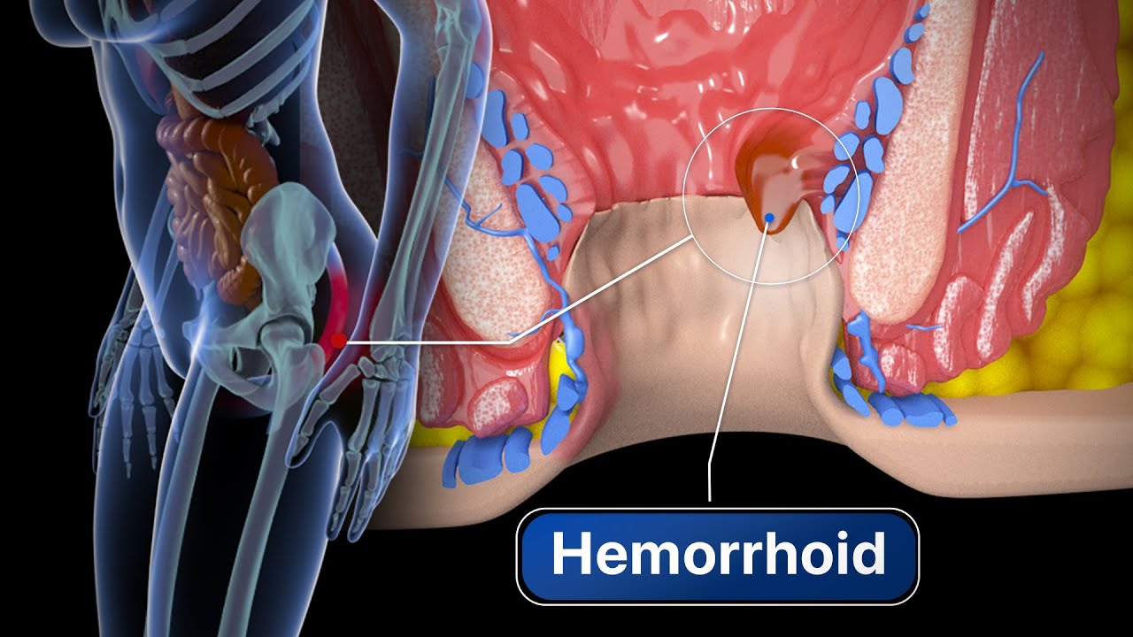 Laparoscopic Surgery for Hydrocele