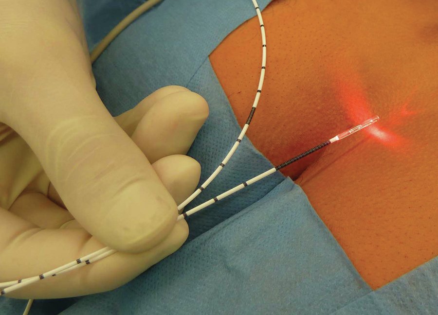 Laser Procedure for Fissure