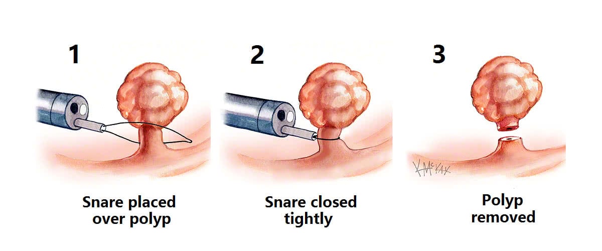 Rectal Polyp Removal Surgery