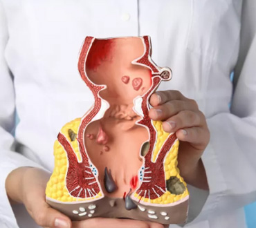 Best Hemorrhoid Surgeon in Dwarka – Dr. Naveen Verma’s Guide to Painless Piles Treatment