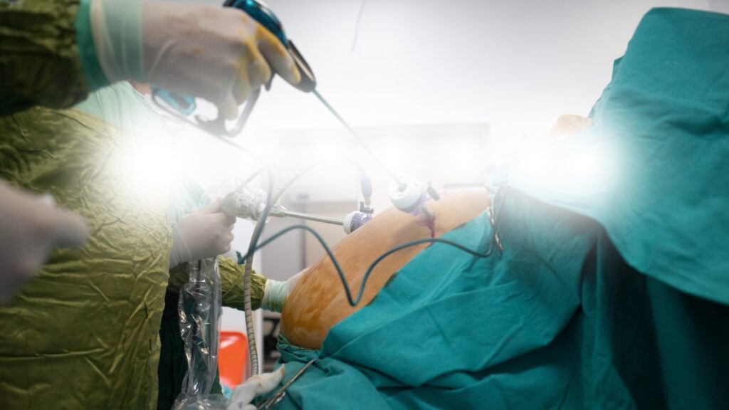 Complete Guide to Bariatric Surgery in Dwarka: Procedure, Care & Expected Results